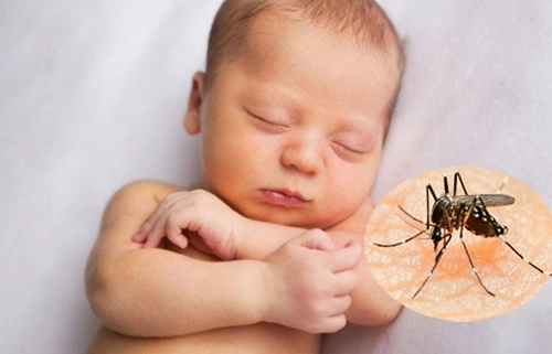 Trẻ sơ sinh nhiễm virus zika có bị hội chứng đầu nhỏ không