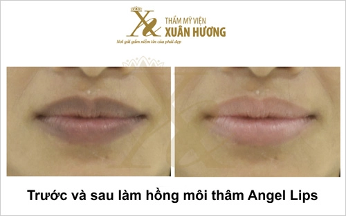 Mẹo đánh bật môi thâm môi khô nứt nẻ trong mùa đông lạnh giá