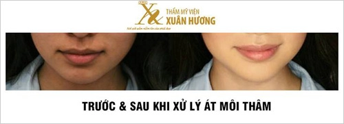 Mẹo đánh bật môi thâm môi khô nứt nẻ trong mùa đông lạnh giá