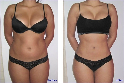 Cùng giảm mỡ toàn thân với công nghệ lipo hifu