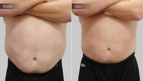 Cùng giảm mỡ toàn thân với công nghệ lipo hifu