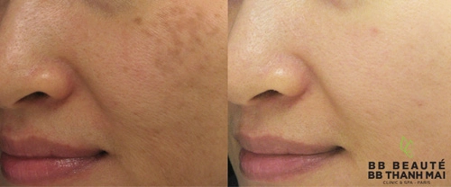Điều trị nám bằng laser không phải lúc nào cũng an toàn