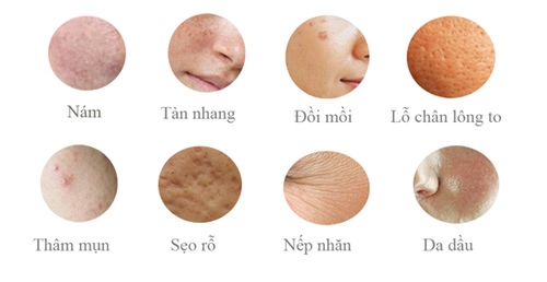 Điều trị nám bằng laser không phải lúc nào cũng an toàn