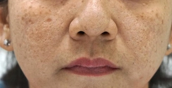 Điều trị nám bằng laser không phải lúc nào cũng an toàn