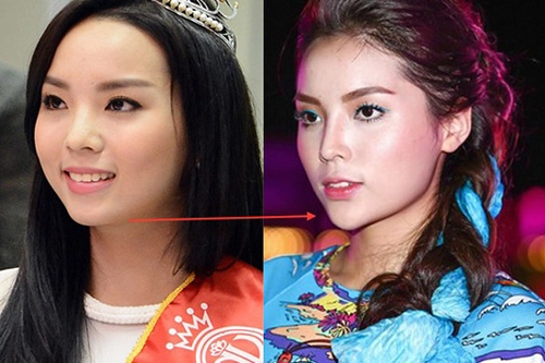 Mặt v-line và những chiếc cằm nhọn hoắt