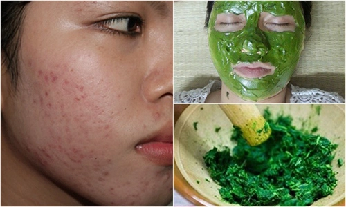 Sẹo lõm mờ đi chỉ với 2 ngàn đồng rau má bạn có biết