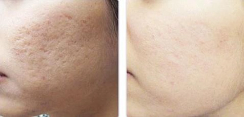 Sẹo lõm mờ đi chỉ với 2 ngàn đồng rau má bạn có biết
