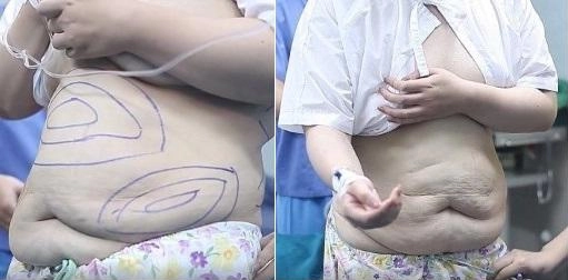 Để phẫu thuật vòng eo 56 cụ bà 60 tuổi phải bất chấp tính mạng