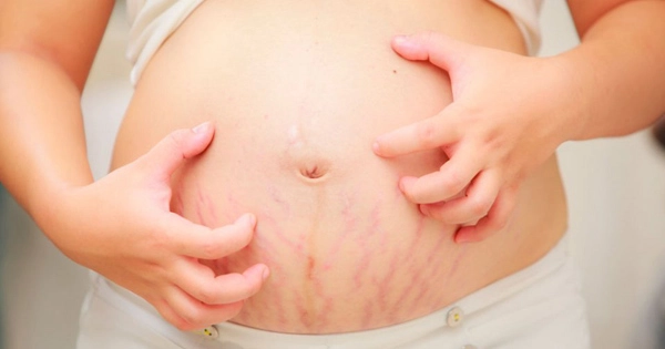 Những giải pháp điều trị rạn da mang thai và sau khi sinh hiệu quả