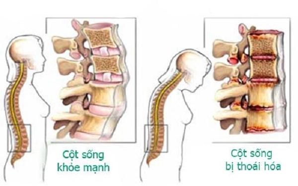 Canh bao nguy hiêm cua bênh côt sông và các dấu hiệu cần chú ý