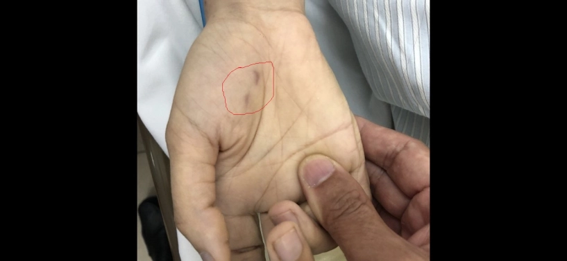 Một bác sĩ thú y đã tử vong do bệnh dại vì chủ quan