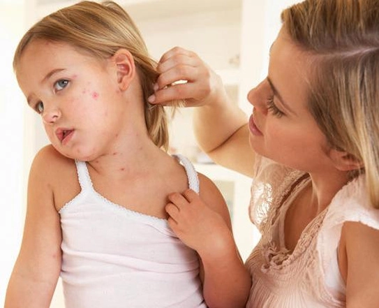 Bệnh thủy đậu nguy hiểm hơn chúng ta tưởng
