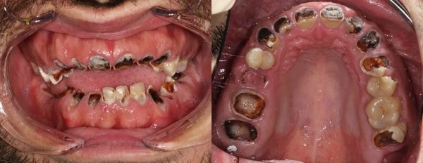 Thanh niên phải trồng lại cả hàm răng vì lý do bất ngờ