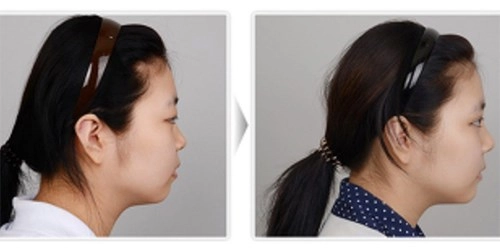Sao hàn nâng mũi nhấn mí giờ cắt cả cơ bắp chân