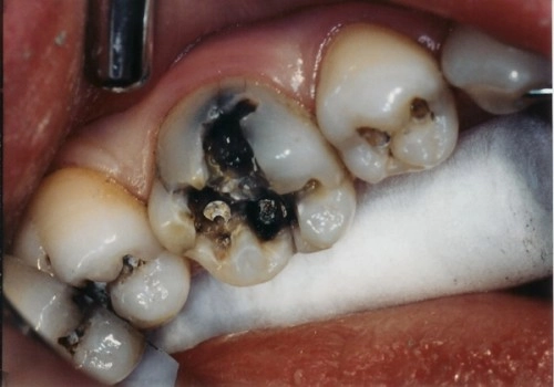 Sâu răng cứng đầu đến đâu cũng bị đánh bại