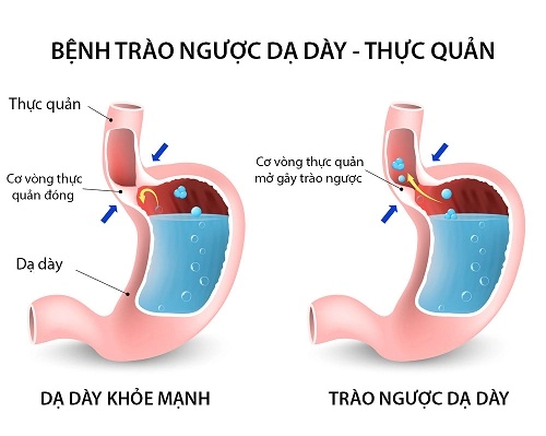 Bệnh trào ngược dạ dày nên ăn và kiêng gì bạn có biết