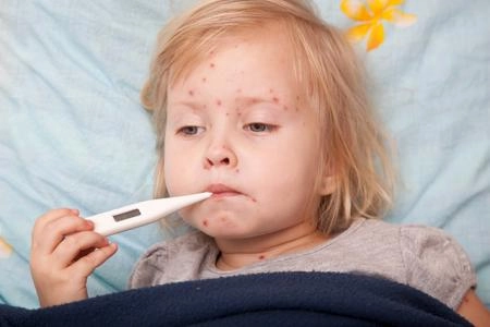 Tránh nhầm lẫn bệnh sởi và sốt phát ban