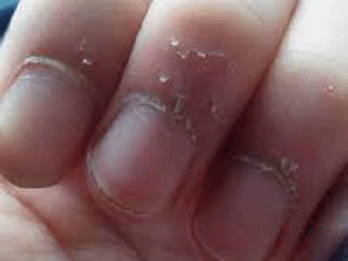 Nhập viện vì thói quen cắn xước măng-rô ngón tay