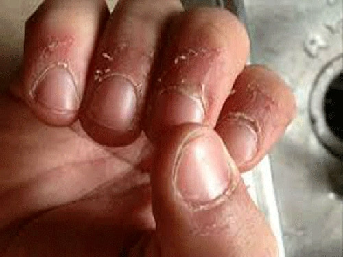 Nhập viện vì thói quen cắn xước măng-rô ngón tay