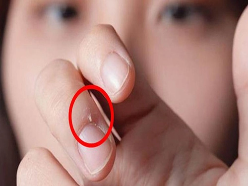 Nhập viện vì thói quen cắn xước măng-rô ngón tay
