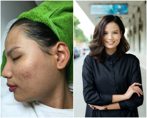 Xôn xao công nghệ trị mụn và trẻ hóa 2 trong 1