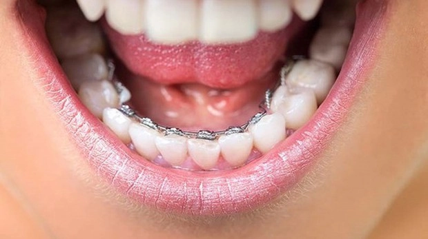 5 kiểu làm đẹp bằng niềng răng để nàng lựa chọn